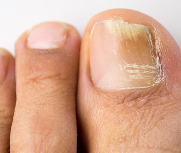 infecție fungică a unghiilor de la picioare