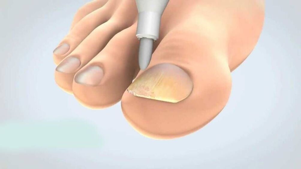tratamentul ciupercii unghiilor de la picioare