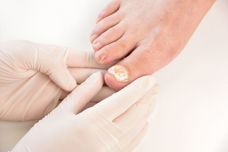 Înainte de a prescrie tratamentul, medicul trebuie să diagnosticheze ciuperca unghiilor de la picioare