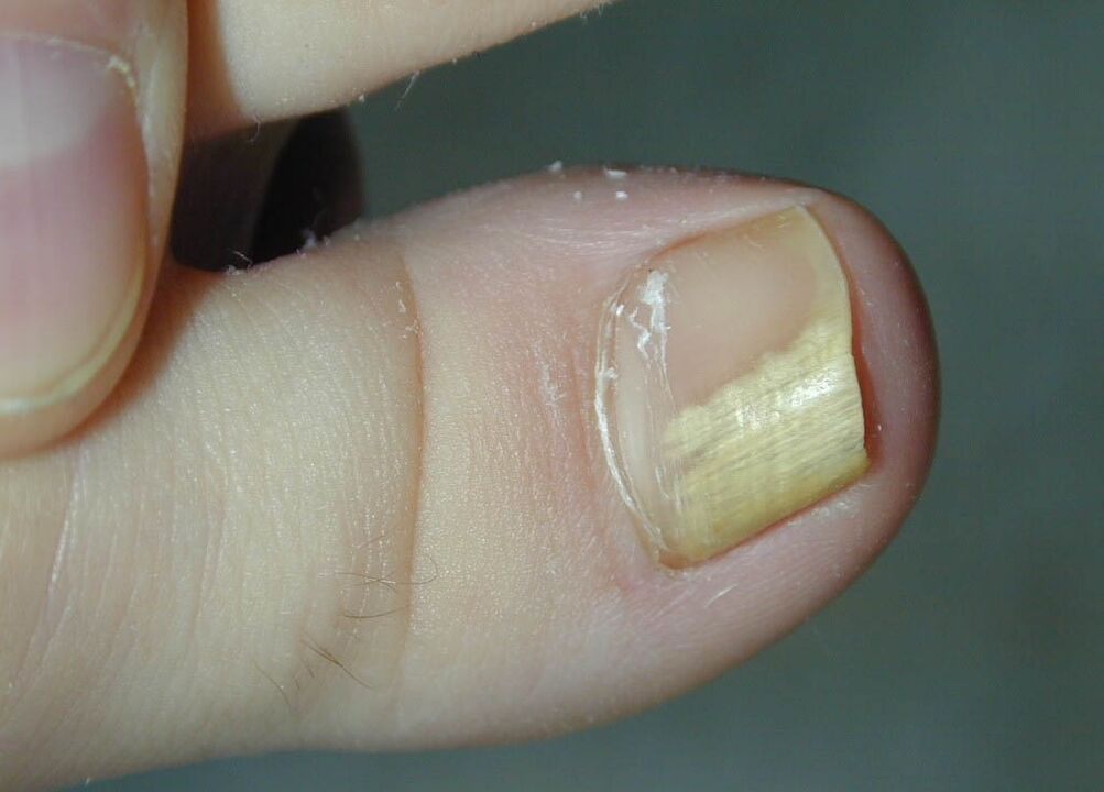 infecție fungică a plăcii unghiei