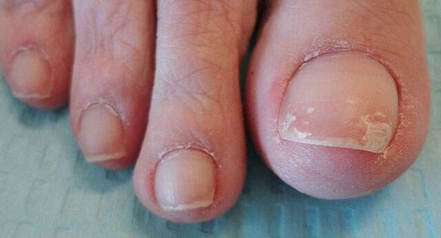 Unul dintre simptomele onicomicozei este desprinderea plăcii unghiei. 