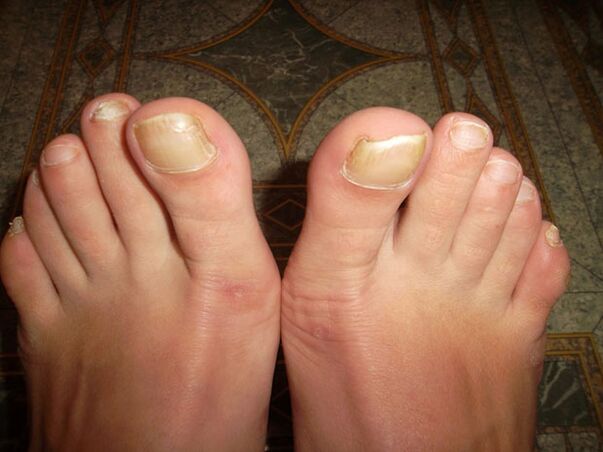 Îngroșarea unghiilor de la picioare cu onicomicoză