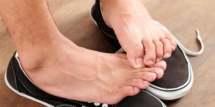 Ciuperca între degetele de la picioare, însoțită de mâncărime și descuamarea pielii