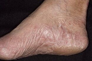 simptome de ciuperca piciorului