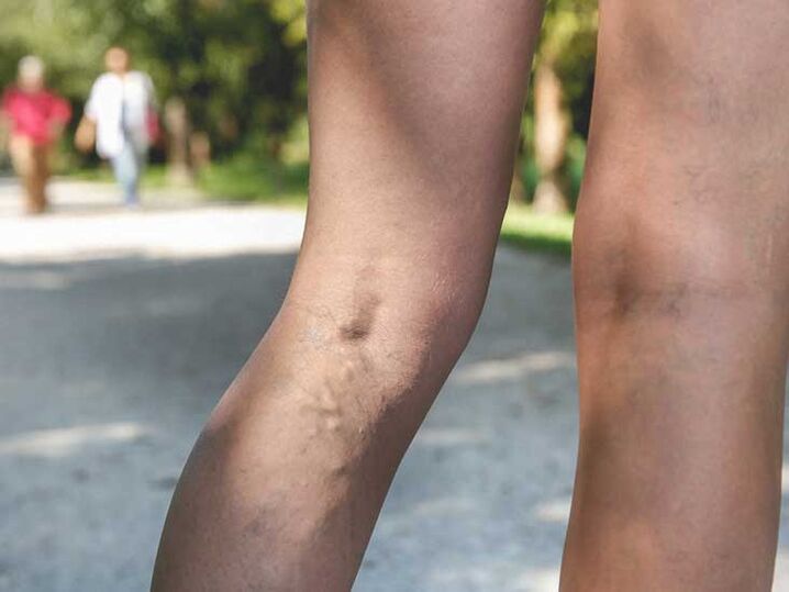 Varicele sunt un factor de risc pentru infecția cu ciuperca piciorului