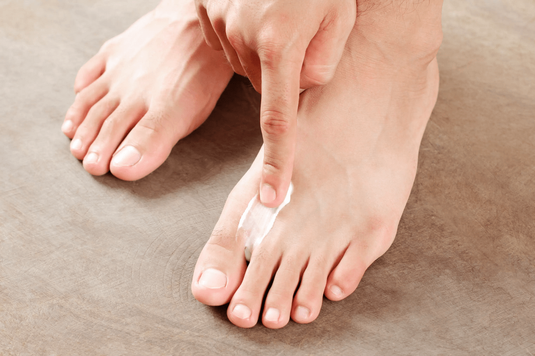 aplicarea unguentului antifungic pe pielea piciorului