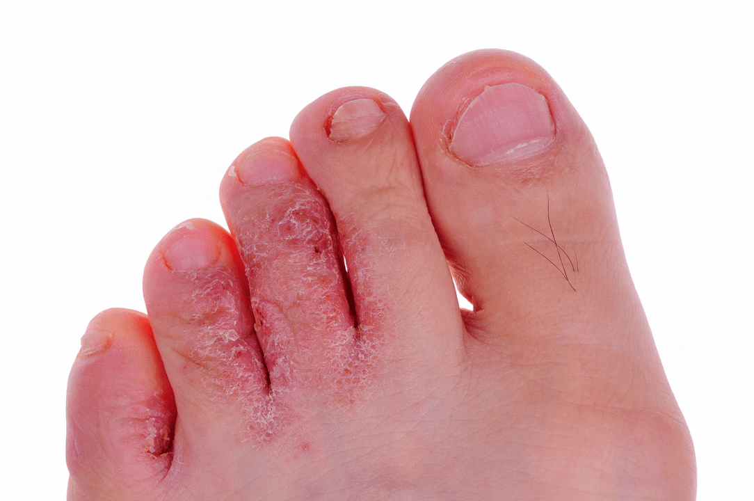 infecție fungică a pielii dintre degetele de la picioare