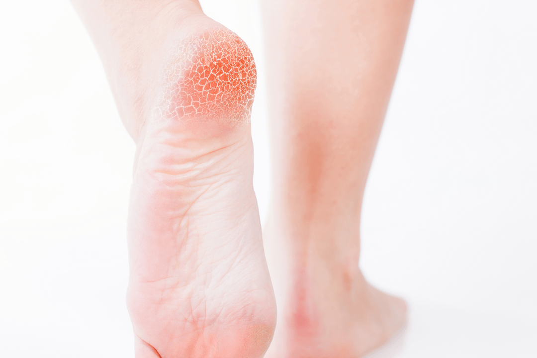 tratamentul ciupercii piciorului în stadiu incipient