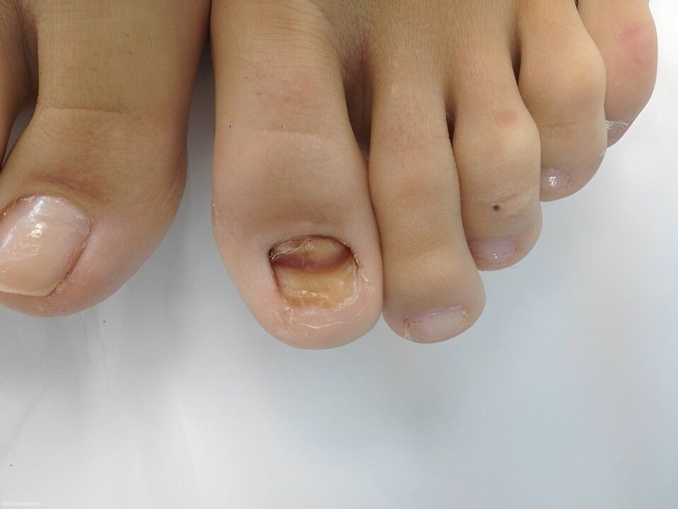 boala fungică a unghiilor