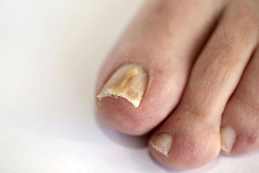 simptome ale ciupercii unghiilor de la picioare