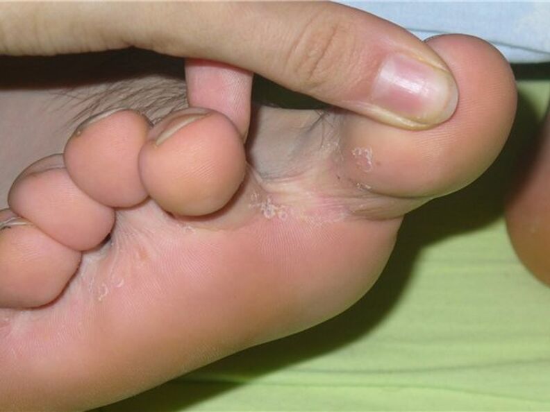 Ciuperca dintre degete