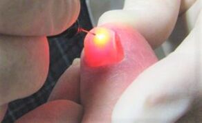 Tratamentul ciupercii de unghii cu un laser