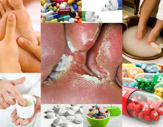 Micoza interdigitală și metode de tratament