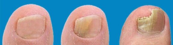 Procesul de dezvoltare a ciupercii