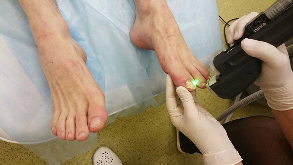 terapie cu laser pentru ciuperca unghiilor