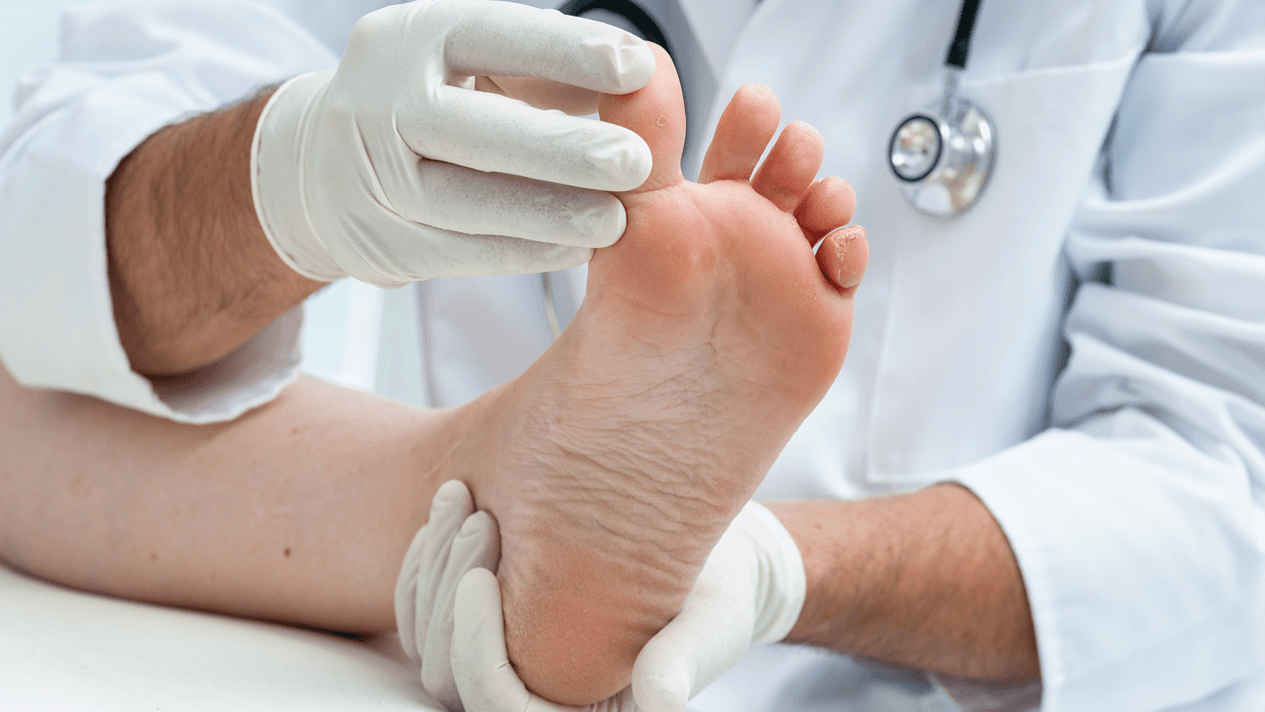 Diagnosticul ciupercii piciorului