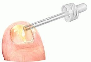 Aplicarea picăturilor medicinale pe o unghie afectată de ciupercă