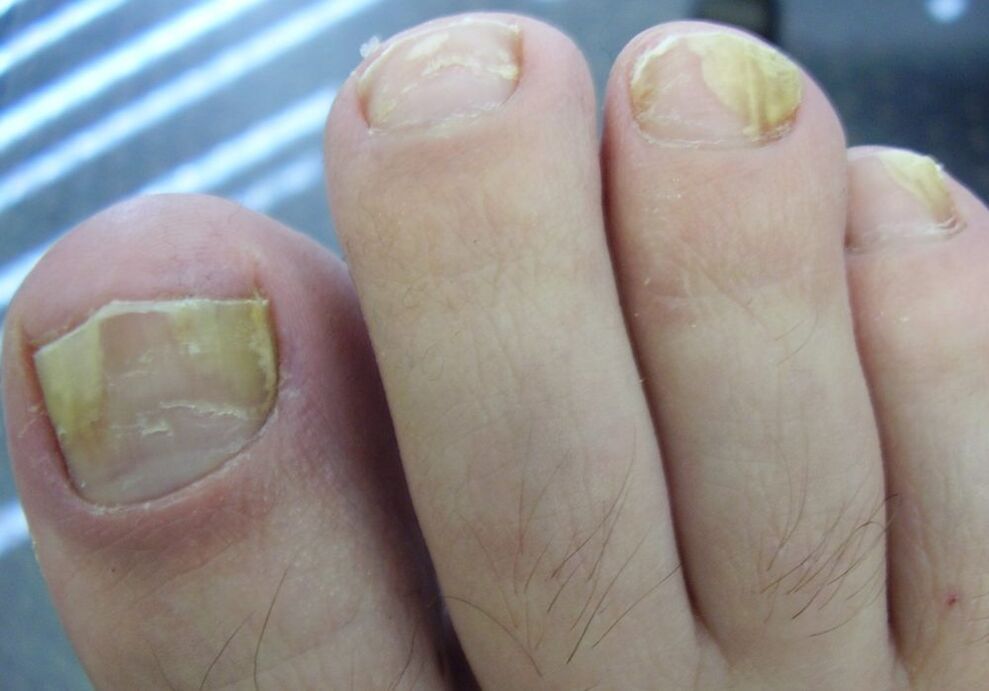Culoarea galbenă a plăcii unghiei în a doua etapă a infecției fungice